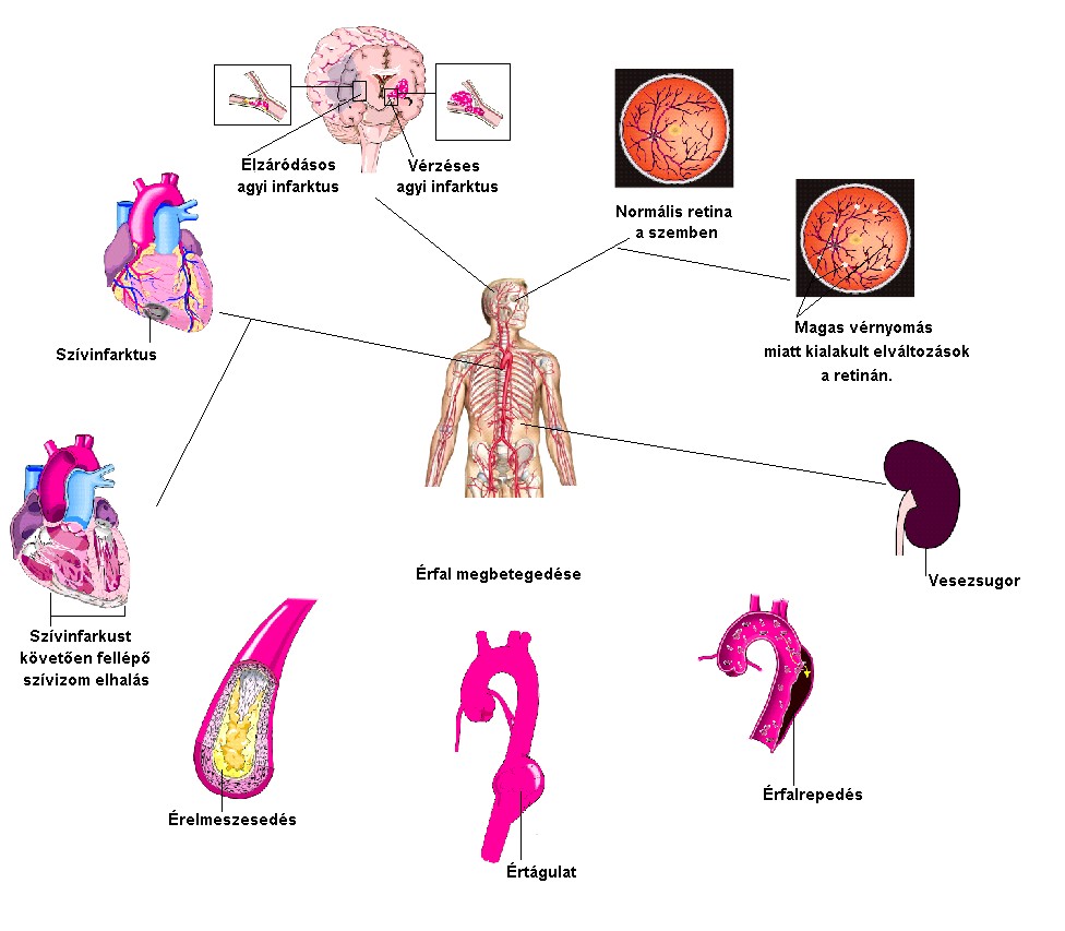 a magas vérnyomás szakaszai és csoportjai)
